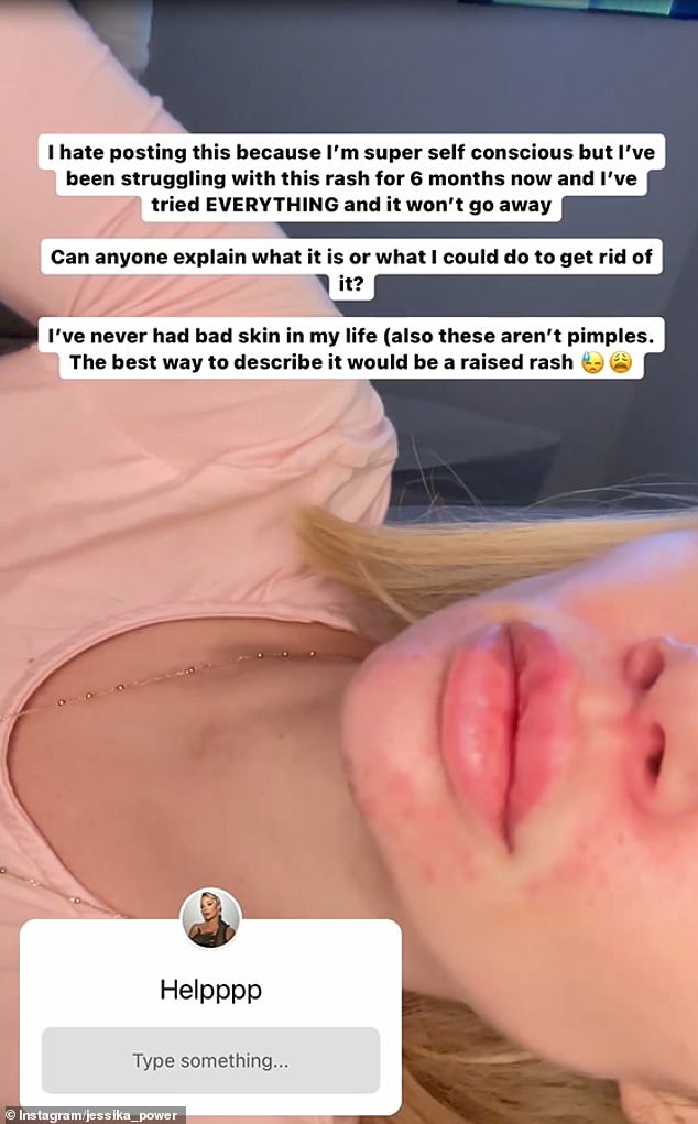 В субботу австралийская звезда реалити-шоу опубликовала в Instagram Stories видео крупным планом, на котором ее подбородок и верхняя часть рта покрыты болезненной красной сыпью.