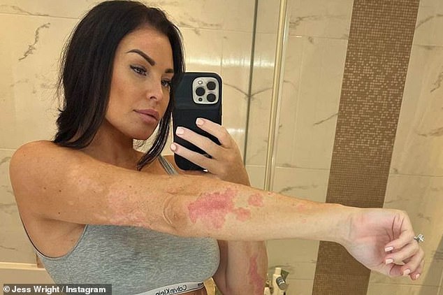 Бывшая звезда TOWIE ранее подробно описывала свое разочарование по поводу этого состояния, поскольку она регулярно страдает от «болезненных» обострений на коже.