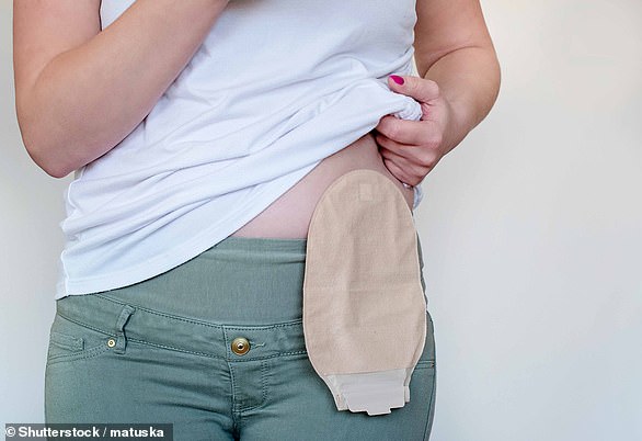 Стома — это хирургически созданное отверстие в брюшной полости, предназначенное для отвода тока мочи и кала.  Использовано стоковое изображение