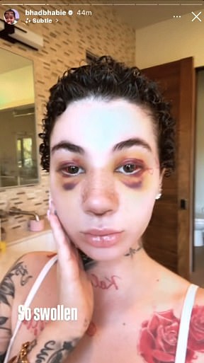 Только в прошлом месяце она удивила поклонников, сделав ринопластику