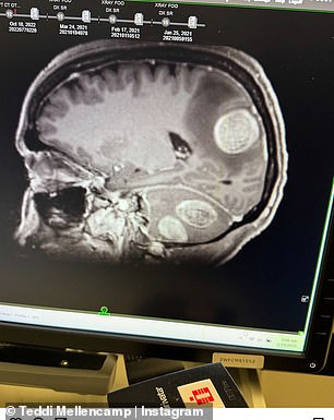 The reality star had four brain tumors removed earlier this year