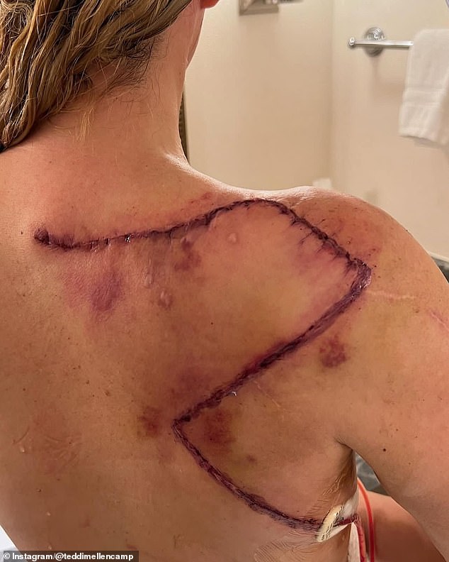 Mellencamp has had 16 surgeries to battle the deadly melanoma attacking her body
